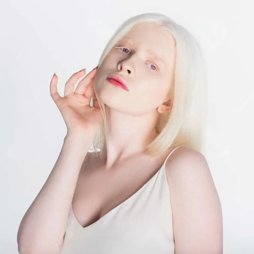 Albino woman